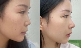杭州整容爆料案件最新,揭开美容行业潜规则与维权困境